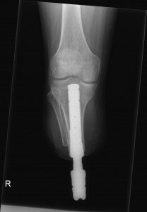 Xray-TT-osseointegartie-208x300.jpeg