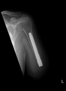 X-humerus_AP-postop-218x300.jpeg